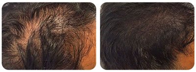 Hair Restoration 